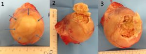 cabeça femoral