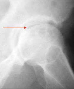 colapso da cabeça femoral
