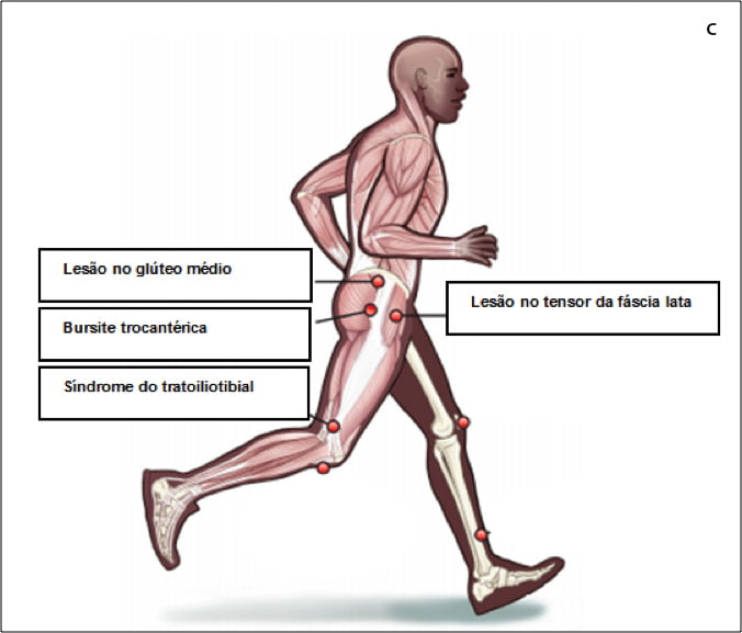 Síndrome do trato ilio tibial, lesão no glúteo médio, bursite trocantérica, lesão no tensor da fáscia lata