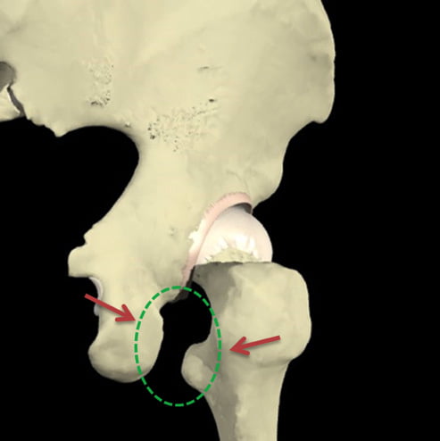 Fig 2 . Vista posterior da região do quadril identificando o túnel isquiofemoral, localizado entre as regiões do isquio e trocânter menor (setas vermelhas).