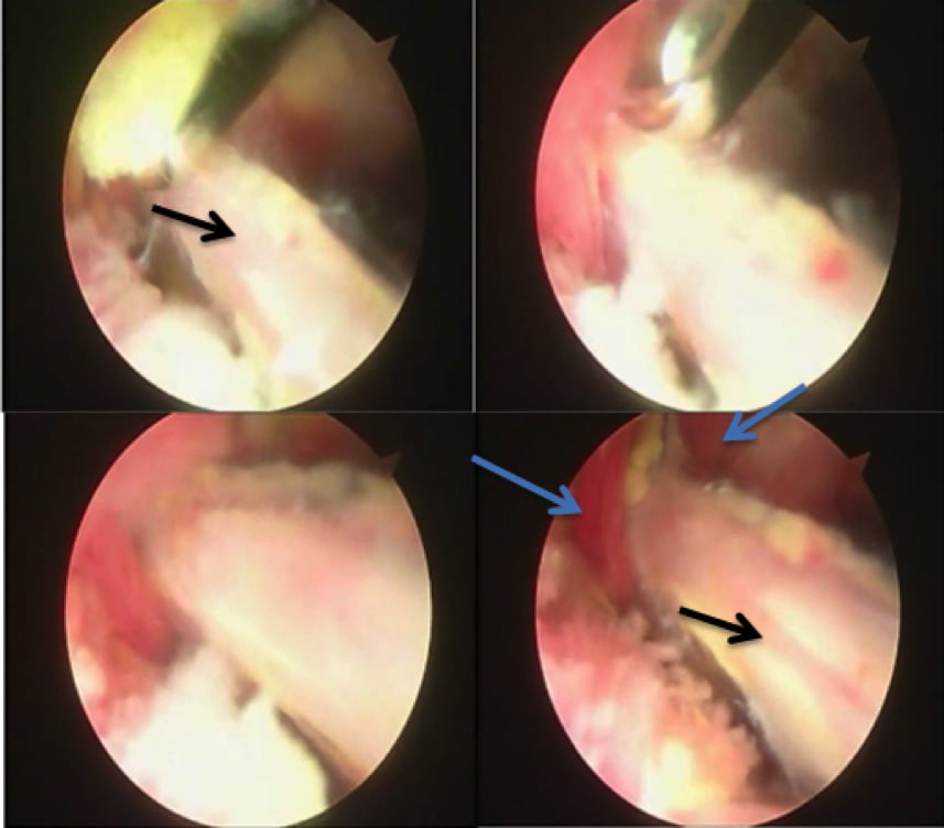 Figura 9. Endoscopia periarticular evidenciando na flecha preta o nervo ciático e com a flecha azul o musculo piriforme. Observe que na última imagem é evidente a musculatura atravessando o nervo pelo meio.