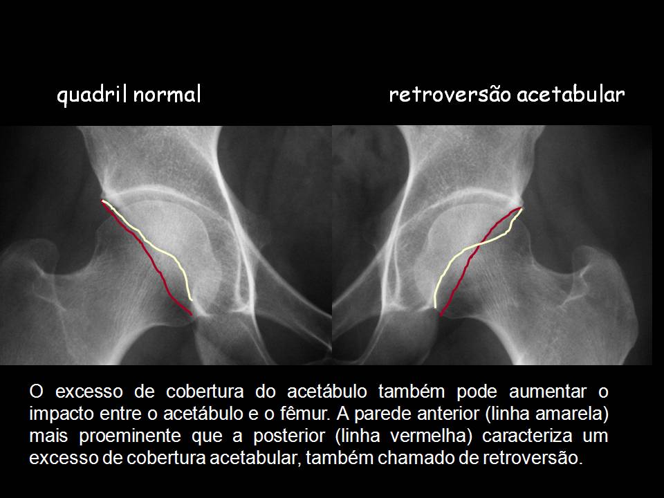 O Que é Proeminência óssea - BRAINCP