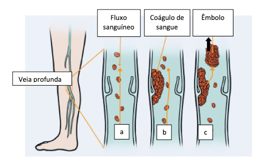Figura 14. (a) As veias da perna contêm pequenas válvulas que ajudam a manter o sangue se movendo em direção ao coração. Lesões, imobilidade e outros fatores podem levar à formação de um coágulo sanguíneo (b) dentro de uma veia da perna. Essa alteração é conhecida como trombose venosa profunda. Um coágulo pode se deslocar (c) (conhecido como embolia) e entra na circulação. Se alojar nos pulmões, pode causar uma embolia pulmonar letal.