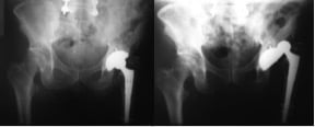 Figura 4. Aspecto da luxação em uma radiografia Aspecto da luxação em uma radiografia