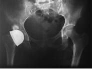 Taça Smith-Petersen implantada